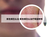 脓包病怎么治 脓包病怎么治疗臀部肿块