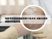 成都专科银屑病医院哪个技术好 成都治银屑病最好的医院是