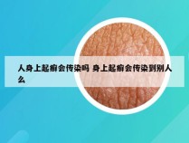 人身上起癣会传染吗 身上起癣会传染到别人么