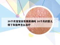 16个月宝宝会生银屑病吗 16个月的婴儿得了灰指甲怎么治疗