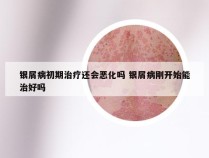 银屑病初期治疗还会恶化吗 银屑病刚开始能治好吗