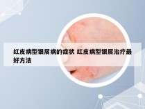 红皮病型银屑病的症状 红皮病型银屑治疗最好方法