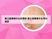 脚上起癣用什么好得快 脚上有癣用什么可以搞好