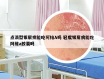 点滴型银屑病能吃阿维A吗 轻度银屑病能吃阿维a胶囊吗