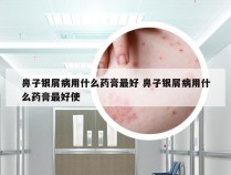 鼻子银屑病用什么药膏最好 鼻子银屑病用什么药膏最好使