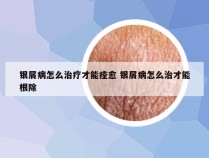 银屑病怎么治疗才能痊愈 银屑病怎么治才能根除