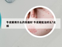 牛皮廨用什么药膏最好 牛皮廨能治好么?止痒