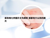 癣有哪几种图片分为哪些 癣都有什么样的图片