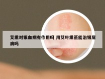 艾熏对银血病有作用吗 用艾叶熏蒸能治银屑病吗