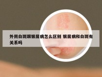 外阴白斑跟银屑病怎么区别 银屑病和白斑有关系吗