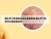 他扎罗汀软膏联合光疗治银屑病 他扎罗汀乳膏可以修复痘坑吗