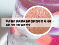 郑州看皮肤病最有名的医院在哪里 郑州哪一家医院看皮肤病更专业