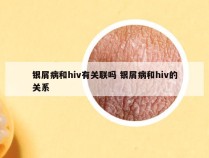 银屑病和hiv有关联吗 银屑病和hiv的关系