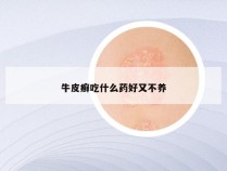 牛皮癣吃什么药好又不养