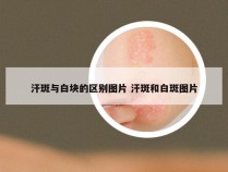 汗斑与白块的区别图片 汗斑和白斑图片