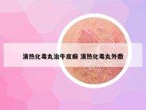 清热化毒丸治牛皮癣 清热化毒丸外敷