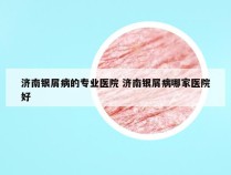 济南银屑病的专业医院 济南银屑病哪家医院好