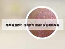 牛皮鲜遗传么 遗传性牛皮鲜几岁能看出来吗