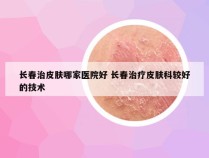 长春治皮肤哪家医院好 长春治疗皮肤科较好的技术