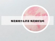 梅花癣用什么药膏 梅花癣好治吗