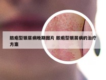 脓疱型银屑病晚期图片 脓疱型银屑病的治疗方案