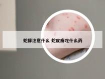 蛇藓注意什么 蛇皮癣吃什么药