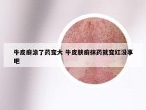 牛皮癣涂了药变大 牛皮肤癣抹药就变红没事吧