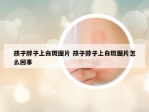 孩子脖子上白斑图片 孩子脖子上白斑图片怎么回事