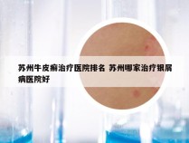 苏州牛皮癣治疗医院排名 苏州哪家治疗银屑病医院好