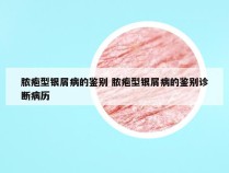 脓疱型银屑病的鉴别 脓疱型银屑病的鉴别诊断病历