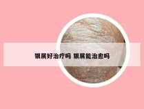 银屑好治疗吗 银屑能治愈吗