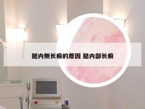 腿内侧长癣的原因 腿内部长癣