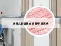 青黛丸副银屑病 青黛膏 银屑病