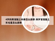 4岁的男宝腿上长癣怎么回事 四岁宝宝腿上长毛是怎么回事