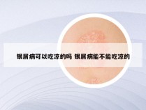 银屑病可以吃凉的吗 银屑病能不能吃凉的