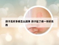 孩子出好多癣怎么回事 孩子起了癣一样的东西