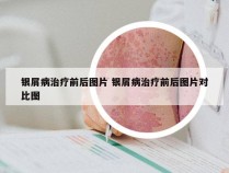 银屑病治疗前后图片 银屑病治疗前后图片对比图