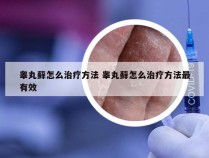 睾丸藓怎么治疗方法 睾丸藓怎么治疗方法最有效