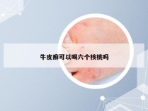 牛皮癣可以喝六个核桃吗