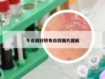 牛皮癣好转有白斑图片图解