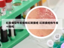 红皮病型牛皮癣和红斑狼疮 红斑狼疮和牛皮一样吗