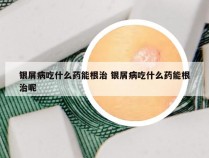 银屑病吃什么药能根治 银屑病吃什么药能根治呢