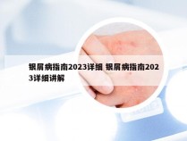 银屑病指南2023详细 银屑病指南2023详细讲解