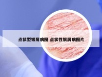 点状型银屑病图 点状性银屑病图片