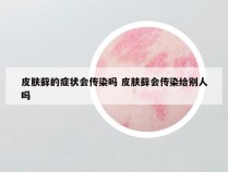 皮肤藓的症状会传染吗 皮肤藓会传染给别人吗