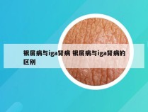 银屑病与iga肾病 银屑病与iga肾病的区别