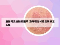 洛阳曙光皮肤科医院 洛阳曙光村看皮肤病怎么样