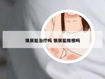 银屑能治疗吗 银屑能除根吗