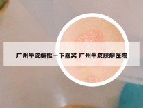 广州牛皮癣枢一下嘉奖 广州牛皮肤癣医院