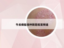 牛皮癣能接种新冠疫苗频道